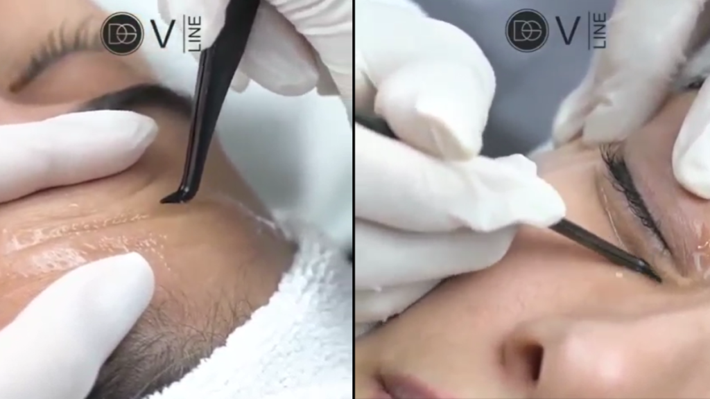 Collageen draad lift schoonheidssalon Purmerend