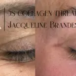 Collageen draad lift oogrimpeltjes behandelen Purmerend