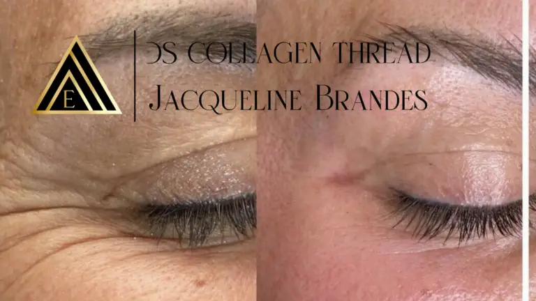 Collageen draad lift oogrimpeltjes behandelen Purmerend