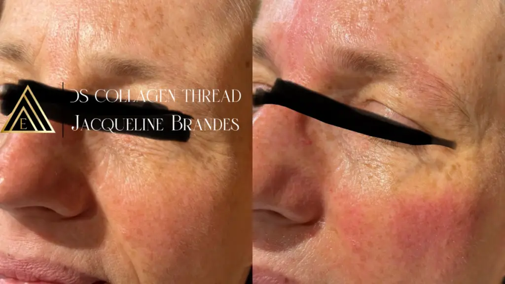 Collageen draad lift Purmerend