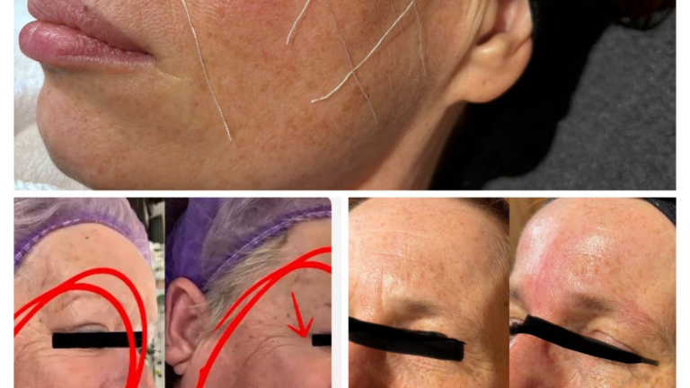 Collageen draad dsv MunayQi salon