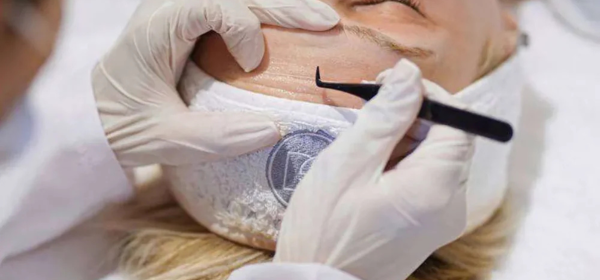 Dsv Collageen draad lift gezichtsbehandeling Purmerend