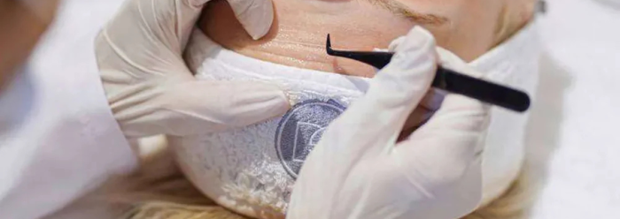 Dsv Collageen draad lift gezichtsbehandeling Purmerend